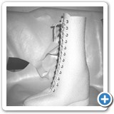 1. a Arthrodeseneinbauteil mit Verkürzung + Badeschuh, img26